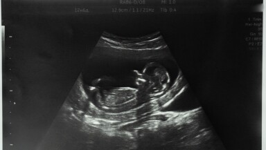 Ρεκόρ αμβλώσεων στη Βρετανία – Σχεδόν 300.000 το 2023